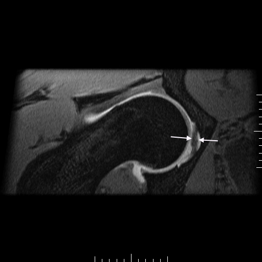 Figure 4 for case Hip Plica